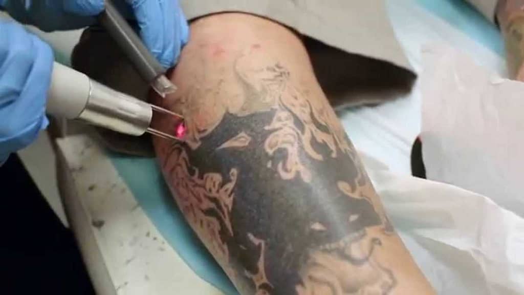 Laser tattoo removal002