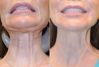 Botox Wrinkles Neck01